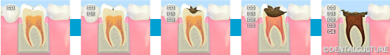 むし歯の発生と進行
