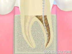 歯内療法