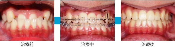 非抜歯矯正