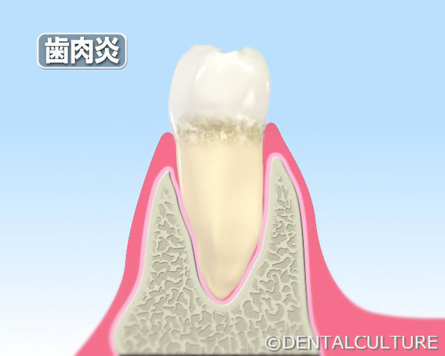 歯周病