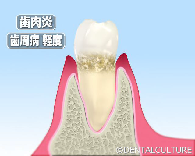 歯周病　軽度