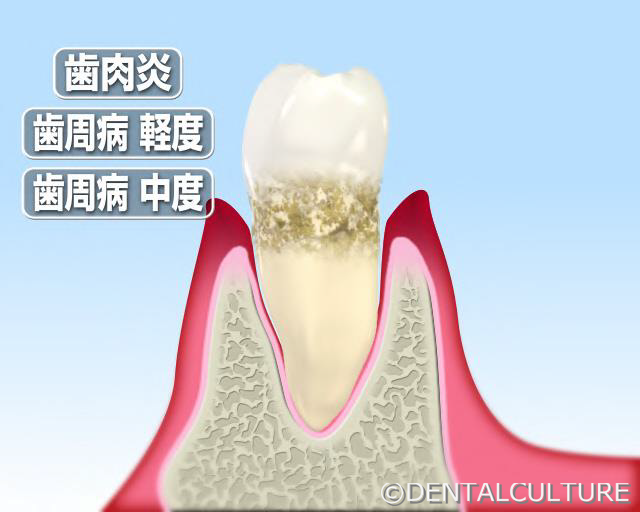 歯周病　中度