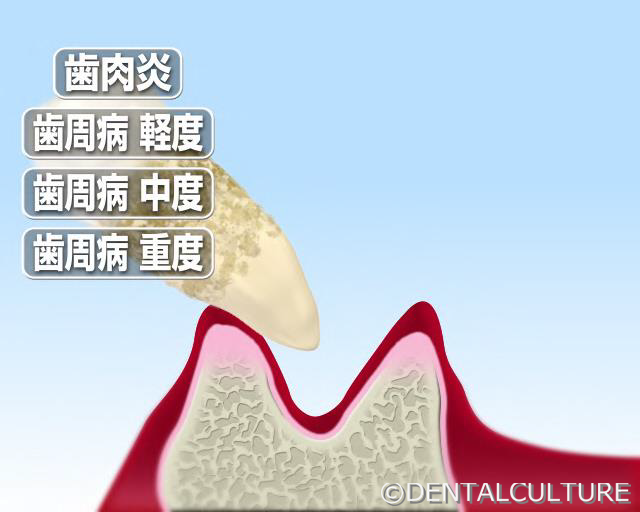 歯周病　重度